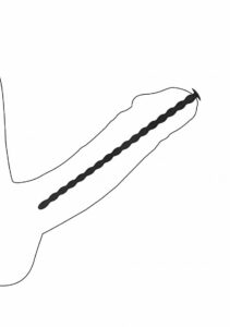 Shots Ouch! Silicone Spiral Screw Advanced Urethral Sound Set - depiction of penis insertion